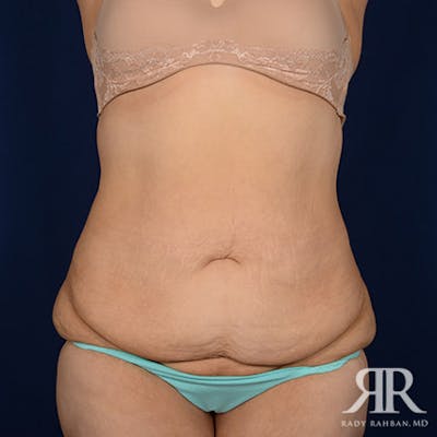 Body Lift Before & After Gallery - Patient 186509 - Image 1
