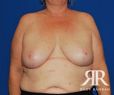 Breast Reduction Before & After Gallery - Patient 537348 - Image 2