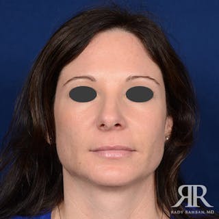 Chin Augmentation Before & After Gallery - Patient 278151 - Image 2