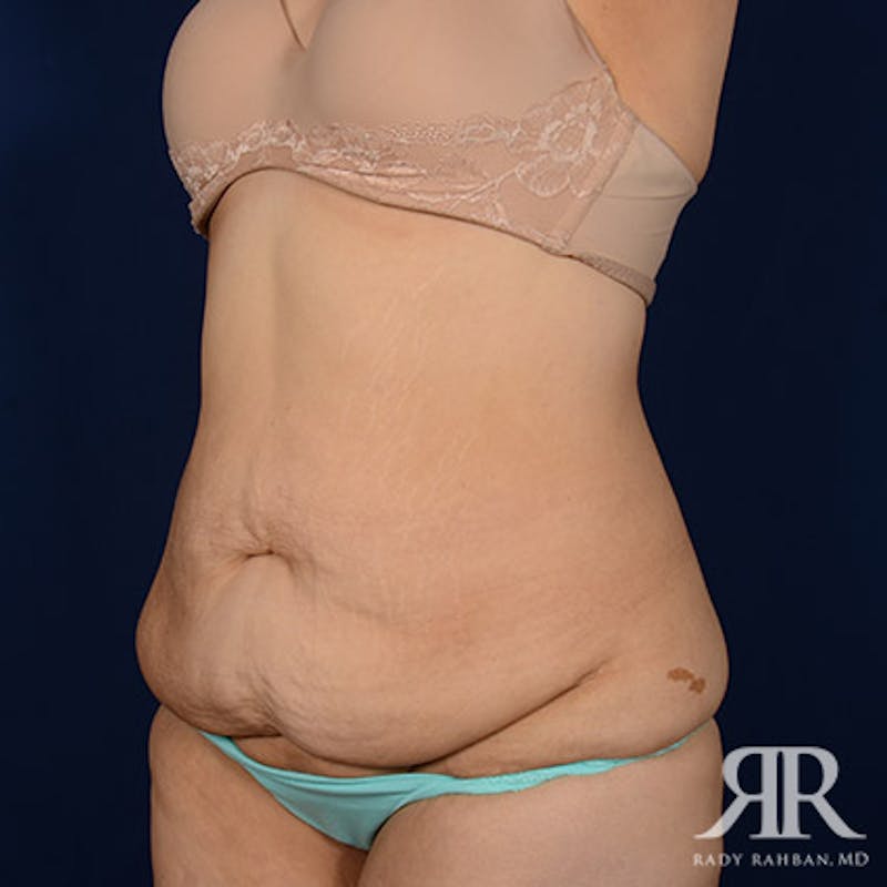 Body Lift Before & After Gallery - Patient 186509 - Image 3