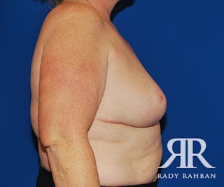 Breast Reduction Before & After Gallery - Patient 537348 - Image 4