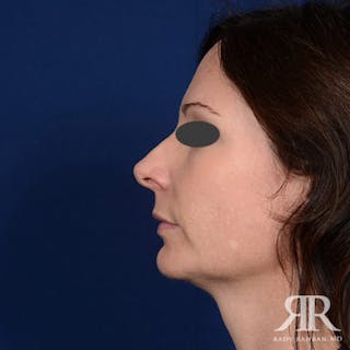 Chin Augmentation Before & After Gallery - Patient 278151 - Image 4