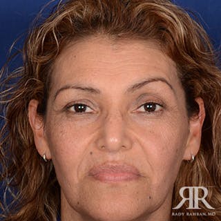 Ethnic Rhinoplasty Before & After Gallery - Patient 907012 - Image 2