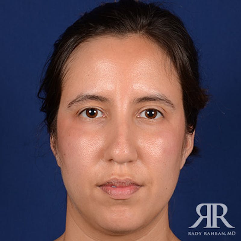 Rhinoplasty w/ Chin Implant Before & After Gallery - Patient 418388 - Image 1