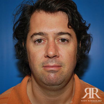 Chin Augmentation Before & After Gallery - Patient 184533 - Image 1