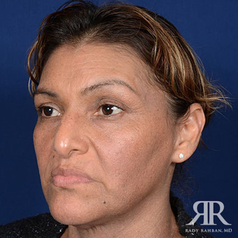 Ethnic Rhinoplasty Before & After Gallery - Patient 907012 - Image 3