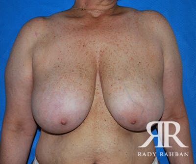 Breast Reduction Before & After Gallery - Patient 739946 - Image 1