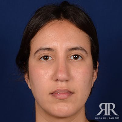 Rhinoplasty w/ Chin Implant Before & After Gallery - Patient 418388 - Image 2