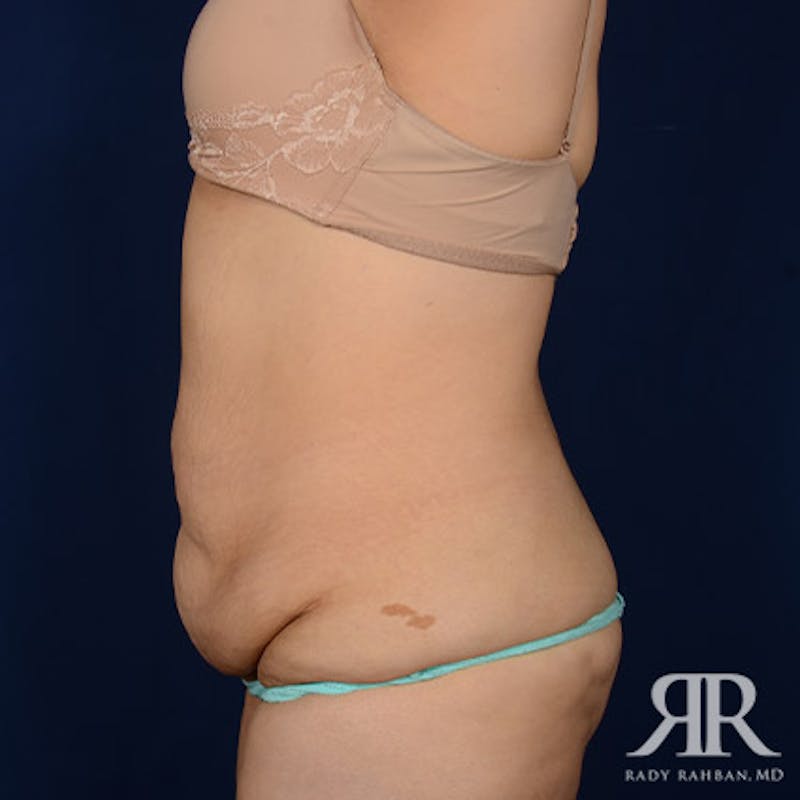 Body Lift Before & After Gallery - Patient 186509 - Image 5