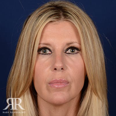 Female Rhinoplasty Before & After Gallery - Patient 101808 - Image 2