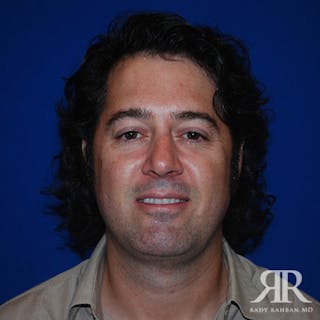 Chin Augmentation Before & After Gallery - Patient 184533 - Image 2