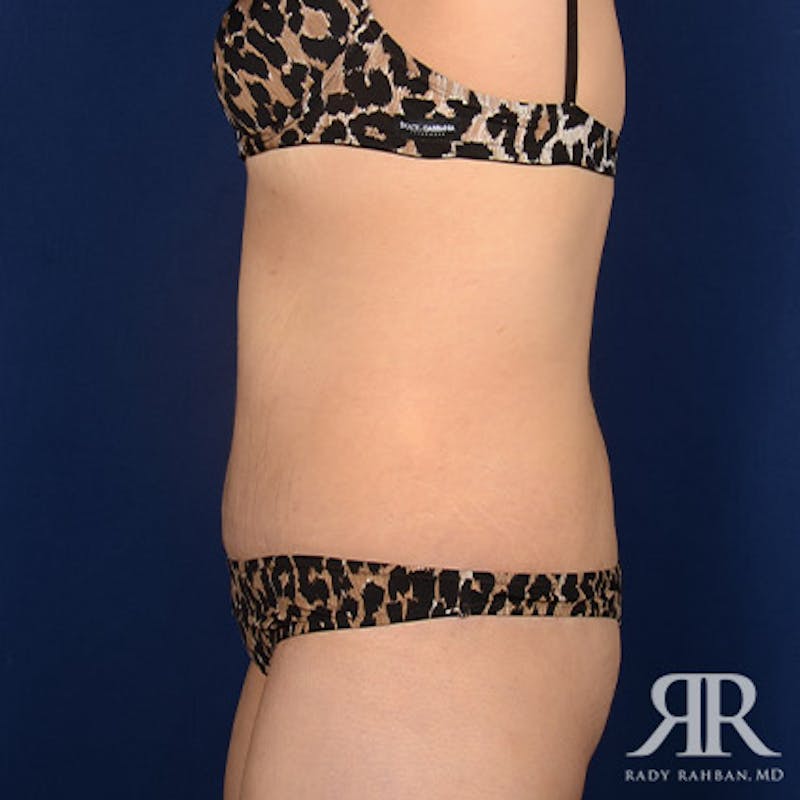 Body Lift Before & After Gallery - Patient 186509 - Image 6