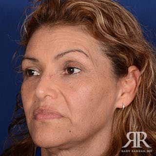 Ethnic Rhinoplasty Before & After Gallery - Patient 907012 - Image 4