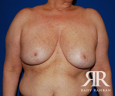 Breast Reduction Before & After Gallery - Patient 739946 - Image 2