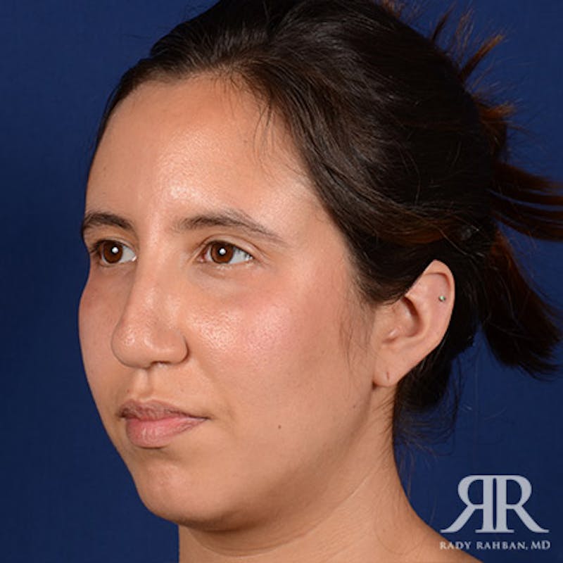 Rhinoplasty w/ Chin Implant Before & After Gallery - Patient 418388 - Image 3
