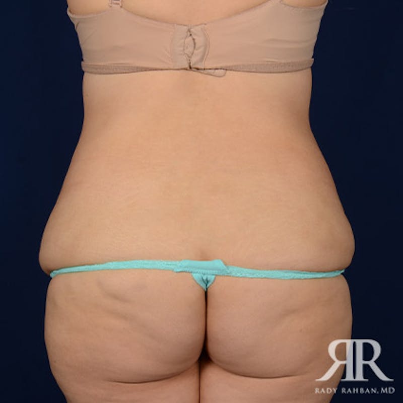 Body Lift Before & After Gallery - Patient 186509 - Image 7