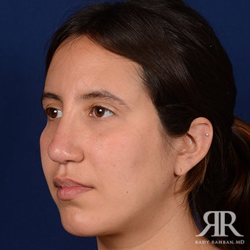 Rhinoplasty w/ Chin Implant Before & After Gallery - Patient 418388 - Image 4