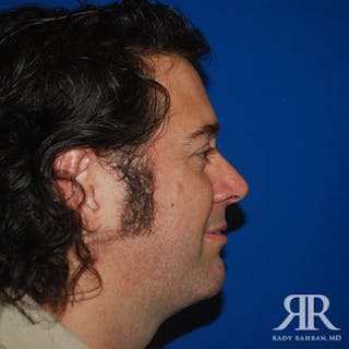 Chin Augmentation Before & After Gallery - Patient 184533 - Image 4