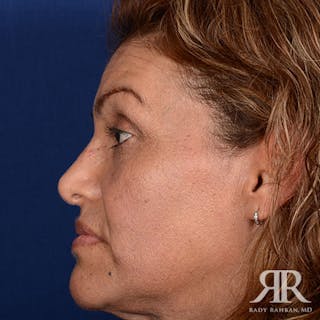 Ethnic Rhinoplasty Before & After Gallery - Patient 907012 - Image 6
