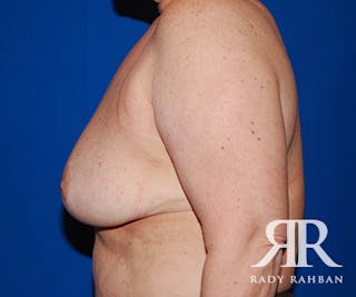 Breast Reduction Before & After Gallery - Patient 739946 - Image 4