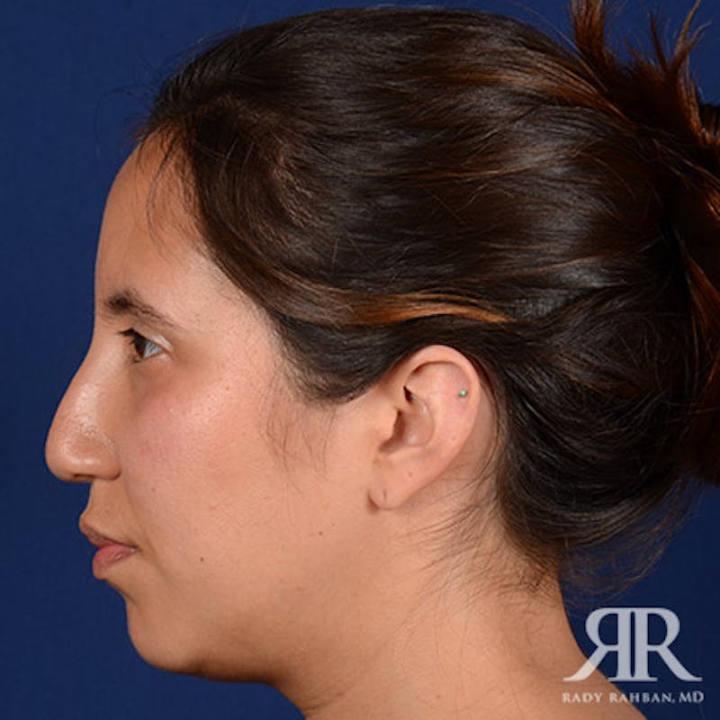 Rhinoplasty w/ Chin Implant Before & After Gallery - Patient 418388 - Image 5