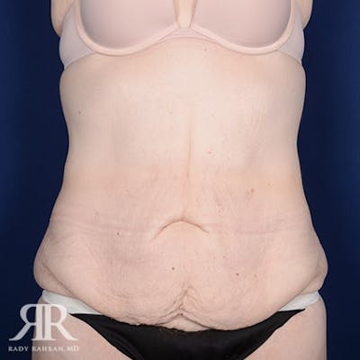 Body Lift Before & After Gallery - Patient 211632 - Image 1