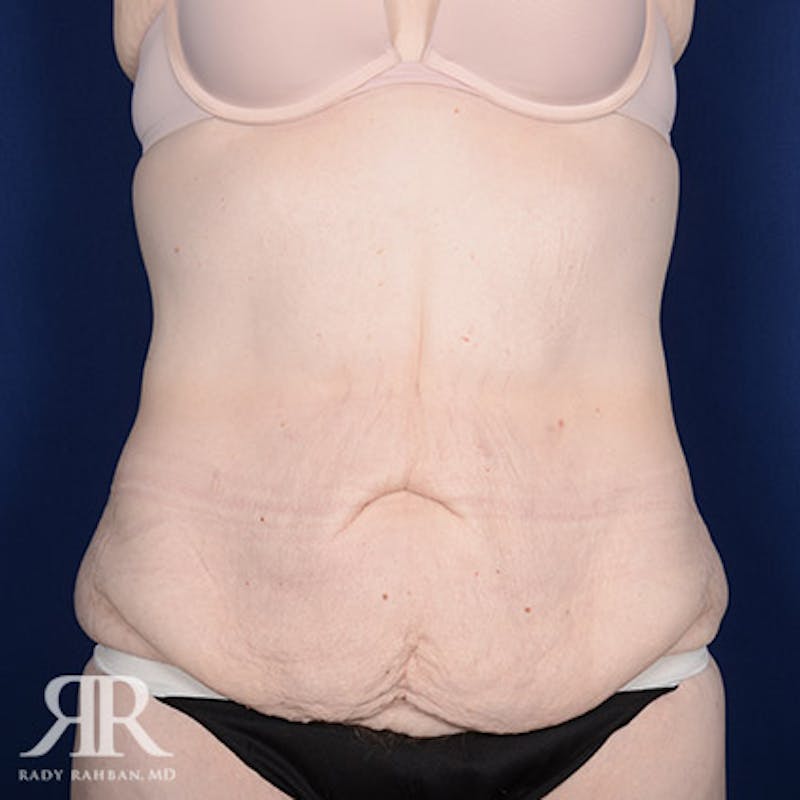 Body Lift Before & After Gallery - Patient 211632 - Image 1