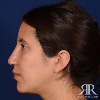 Rhinoplasty w/ Chin Implant Before & After Gallery - Patient 418388 - Image 6