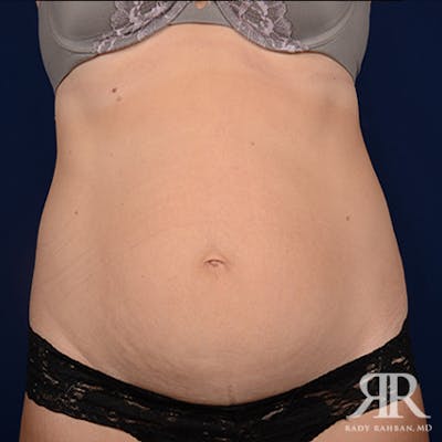 Severe Diastasis Recti Before & After Gallery - Patient 396485 - Image 1