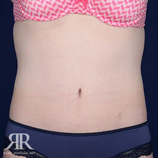 Body Lift Before & After Gallery - Patient 211632 - Image 2