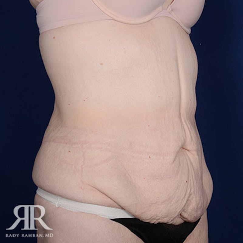 Body Lift Before & After Gallery - Patient 211632 - Image 3