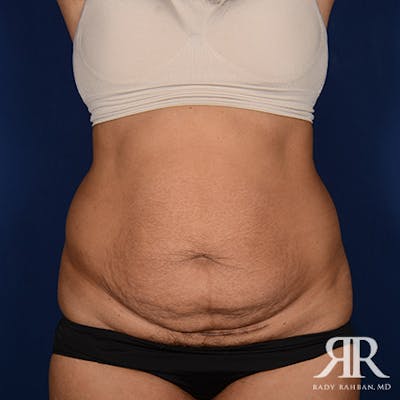 Tummy Tuck Before & After Gallery - Patient 419641 - Image 1