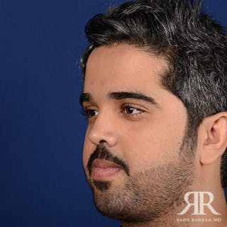 Chin Augmentation Before & After Gallery - Patient 407221 - Image 4