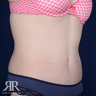 Body Lift Before & After Gallery - Patient 211632 - Image 4