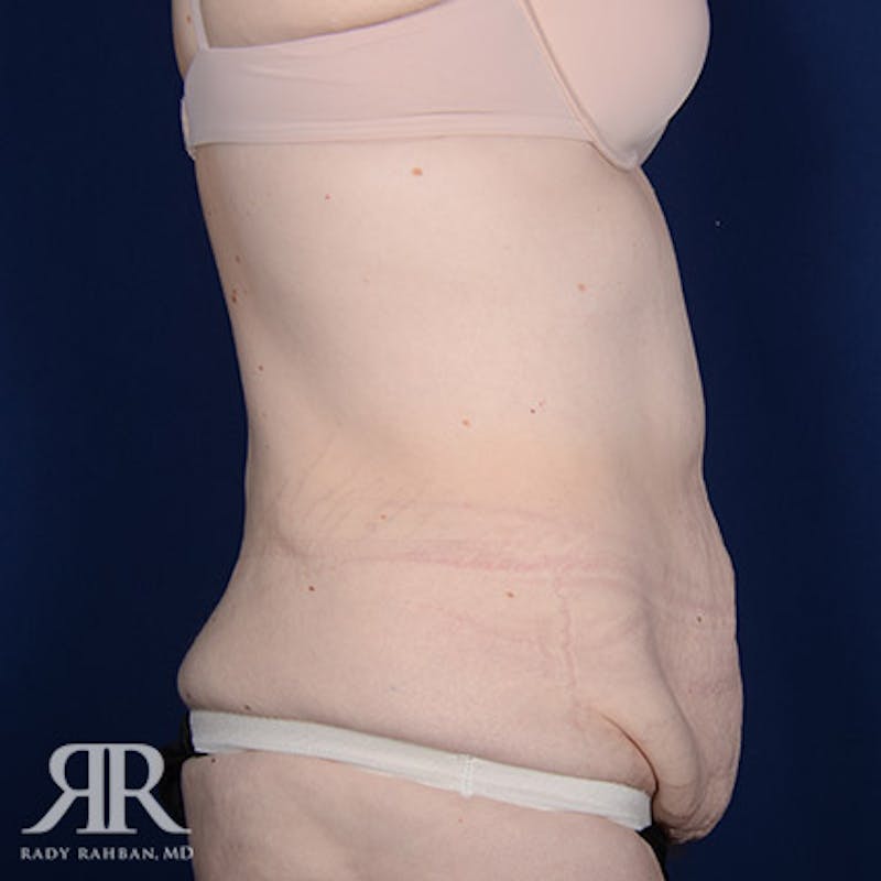 Body Lift Before & After Gallery - Patient 211632 - Image 5