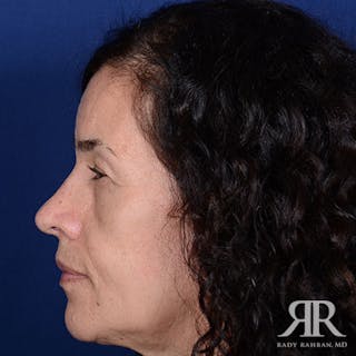 Ethnic Rhinoplasty Before & After Gallery - Patient 852432 - Image 6