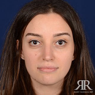 Female Rhinoplasty Before & After Gallery - Patient 424861 - Image 2