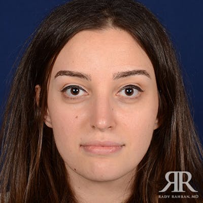 Female Rhinoplasty Before & After Gallery - Patient 424861 - Image 2