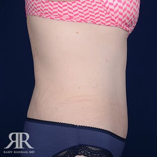 Body Lift Before & After Gallery - Patient 211632 - Image 6