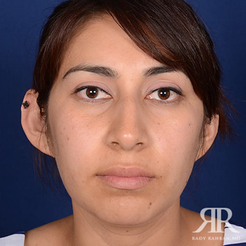 Chin Augmentation Before & After Gallery - Patient 129881 - Image 1