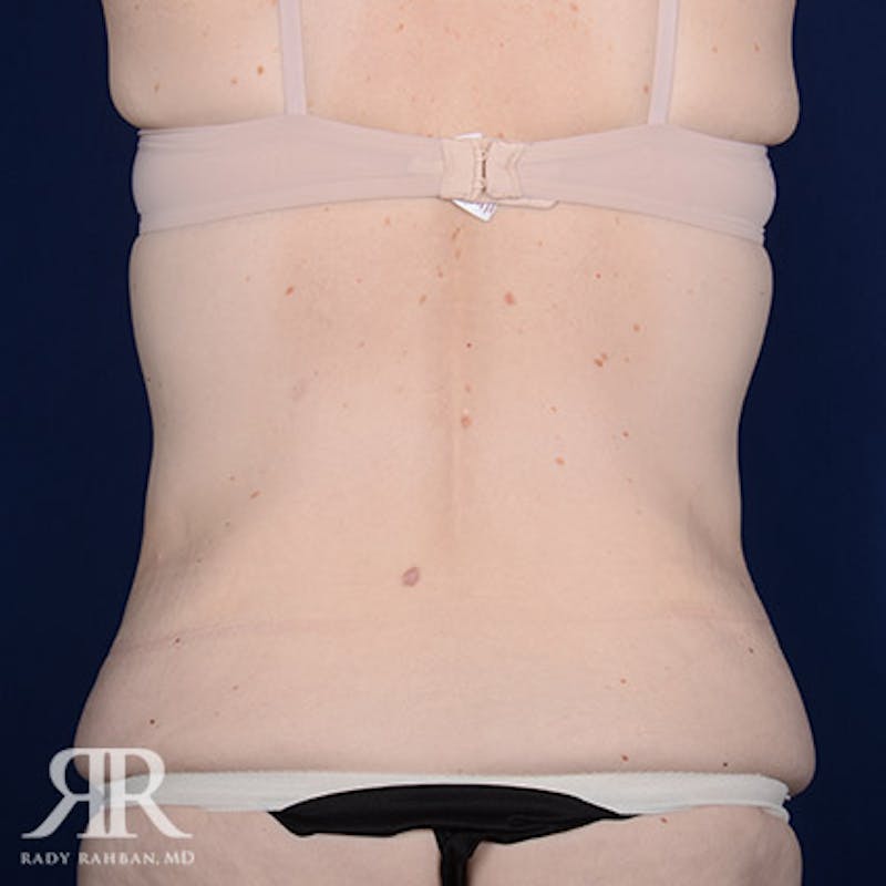 Body Lift Before & After Gallery - Patient 211632 - Image 7
