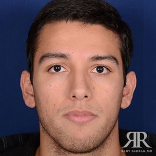 Ethnic Rhinoplasty Before & After Gallery - Patient 364379 - Image 2
