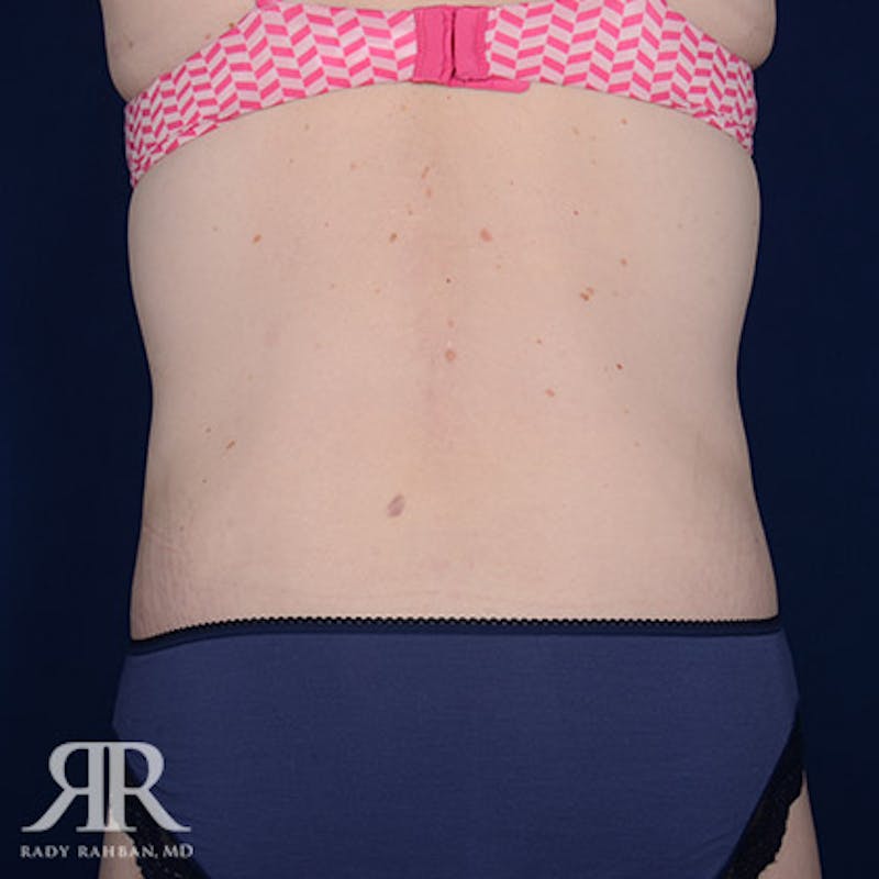 Body Lift Before & After Gallery - Patient 211632 - Image 8