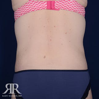Body Lift Before & After Gallery - Patient 211632 - Image 8