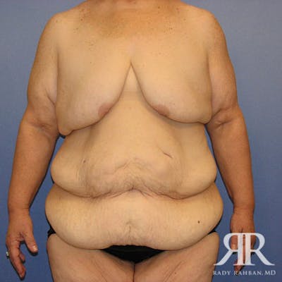 Body Lift Before & After Gallery - Patient 498644 - Image 1