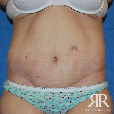 Body Lift Before & After Gallery - Patient 498644 - Image 2