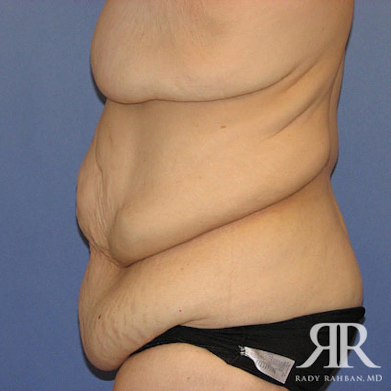 Body Lift Before & After Gallery - Patient 498644 - Image 3