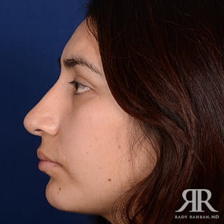 Chin Augmentation Before & After Gallery - Patient 129881 - Image 6