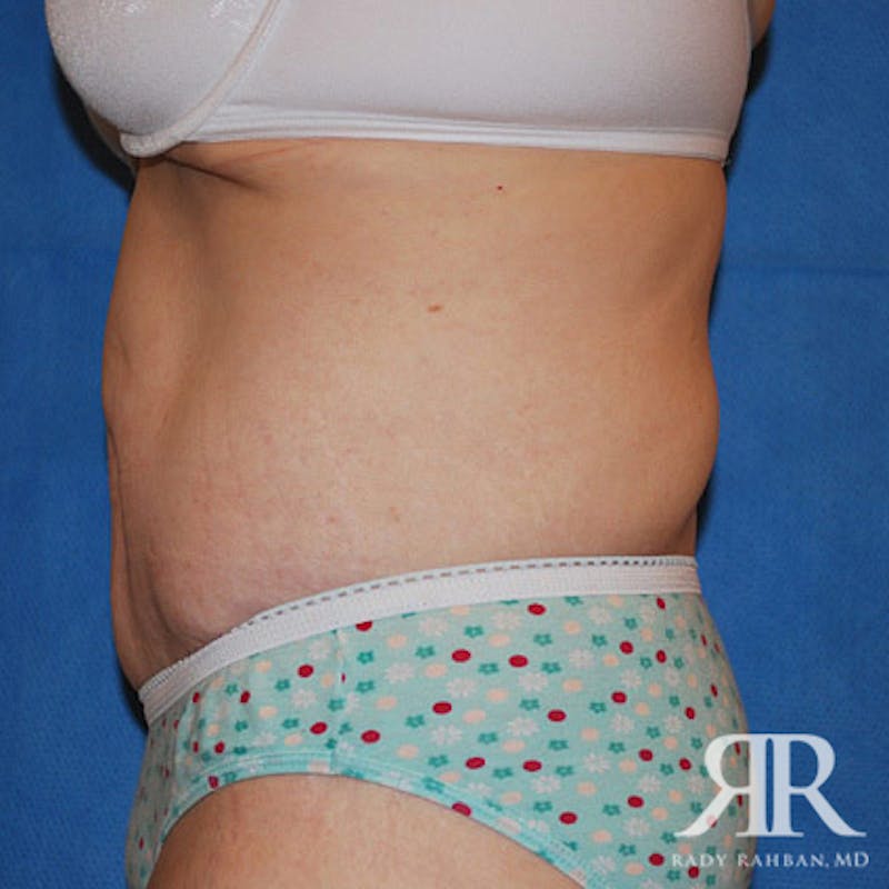 Body Lift Before & After Gallery - Patient 498644 - Image 4