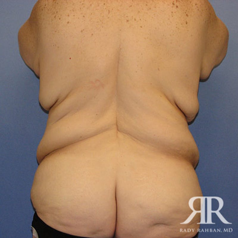 Body Lift Before & After Gallery - Patient 498644 - Image 5
